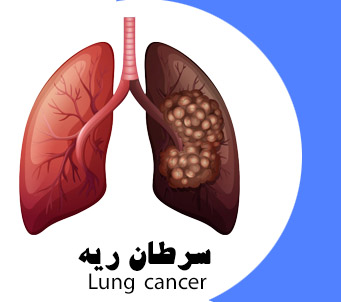 بهترین متخصص سرطان ریه در تهران