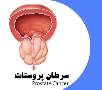 بهترین متخصص درمان سرطان پروستات در تهران