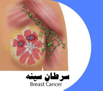 بهترین فوق تخصص سرطان سینه در تهران